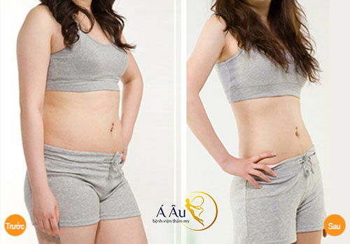 Trước và sau căng da bụng sau sinh